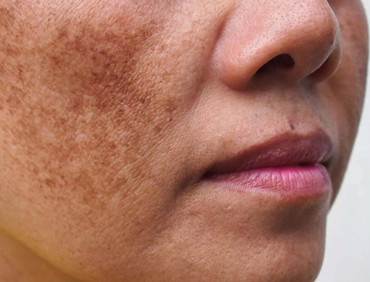 Microneeling du visage à Laval chez Browgeous Esthétique. Soin facial réalisé avec des micro-aiguilles.