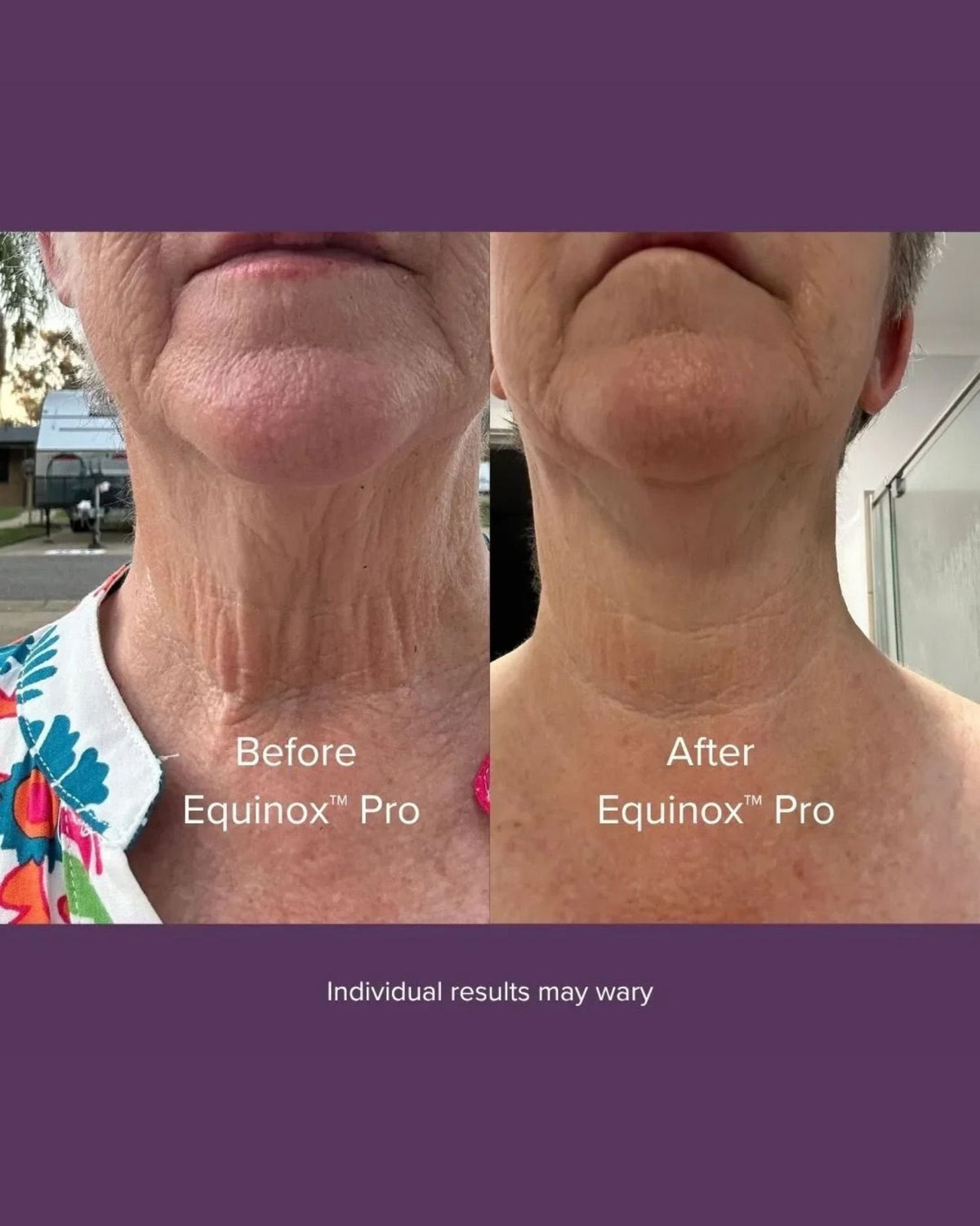 Avant Après Masque luminothérapie pour le visage, cou et poitrine, Before After LED face, neck and chest mask light therapy Equinox Pro Luyors