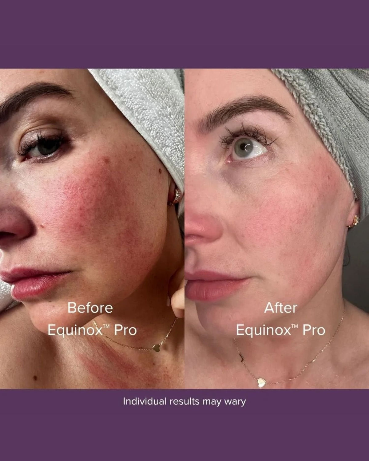 Avant Après Masque luminothérapie pour le visage, cou et poitrine, Before After LED face, neck and chest mask light therapy Equinox Pro Luyors
