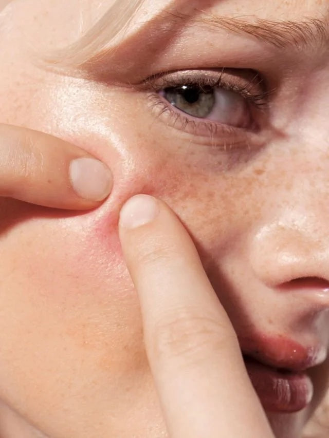 Microneeling du visage à Laval chez Browgeous Esthétique. Soin facial réalisé avec des micro-aiguilles.